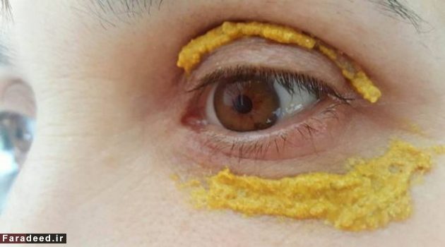 درمان سیاهی دور چشم/جادوی زردچوبه چه می‌کند؟