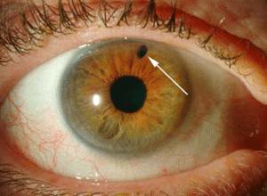 پیشگیری از آب سیاه با مصرف سبزیجات سبز