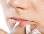 درمان های طبیعی تبخال